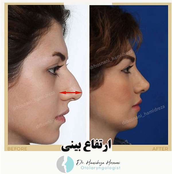 definition of nose height or projection