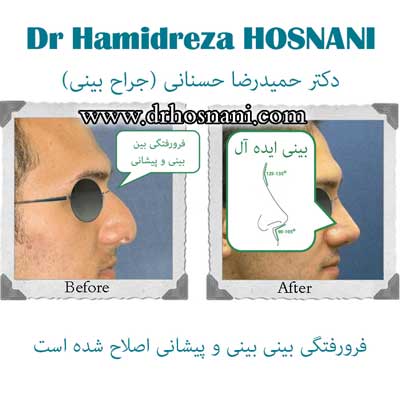 بینی ایده ال