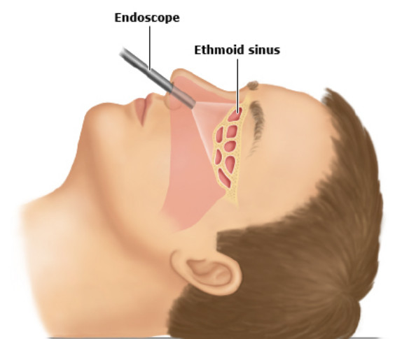 endoscopy assisted rhinoplasty og