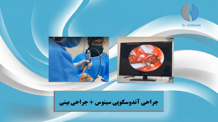 جراحی آندوسکوپی سینوس + جراحی بینی