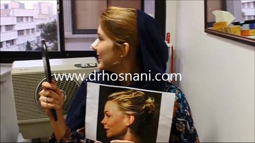 نتیجه جراحی بینی