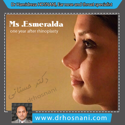 Esmeralda One Year After Surgery