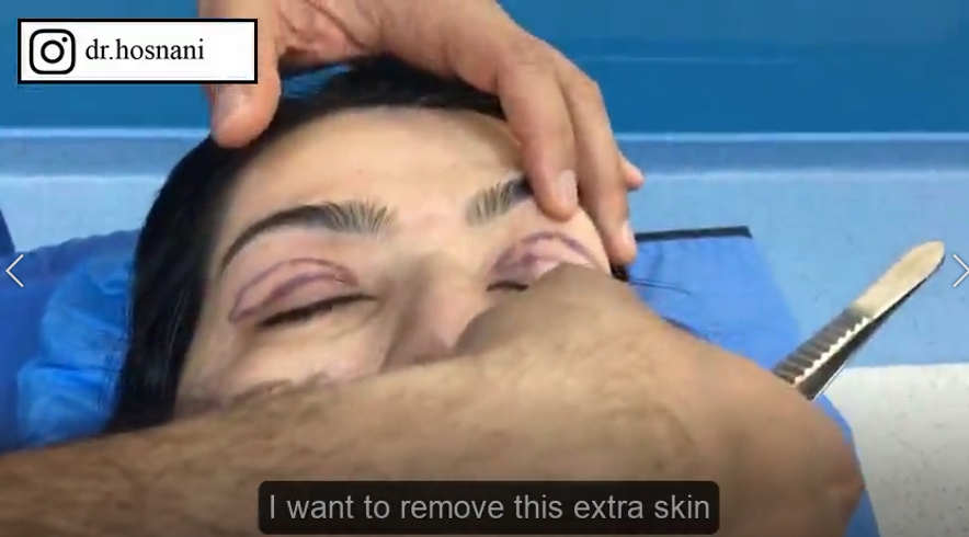 extra skin to be removed