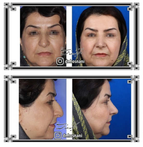 eyelid surgery result