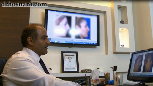 feminine nose surgery og