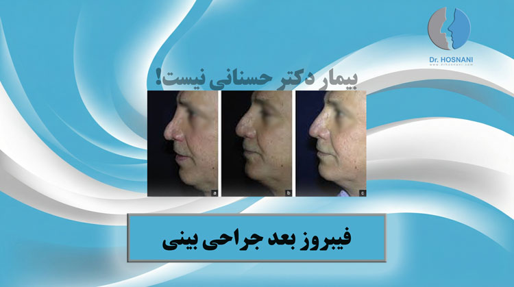 فیبروز بینی بعد از جراحی