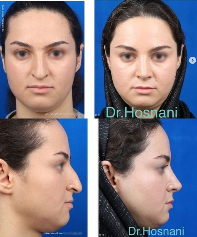اصلاحات بینی استخوانی