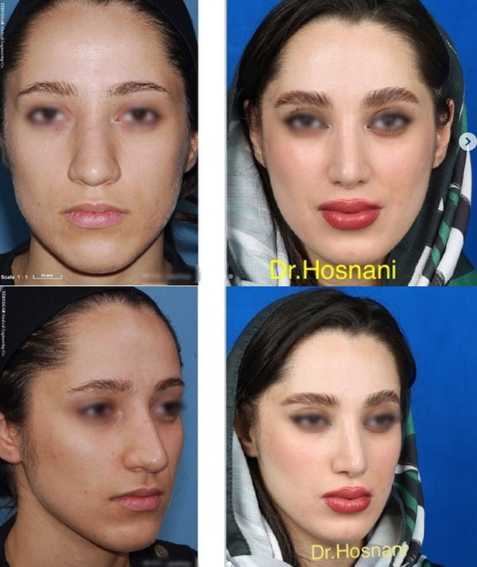 قبل و بعد بینی نیمه گوشتی