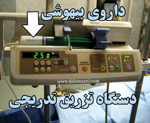 gradual anesthesia