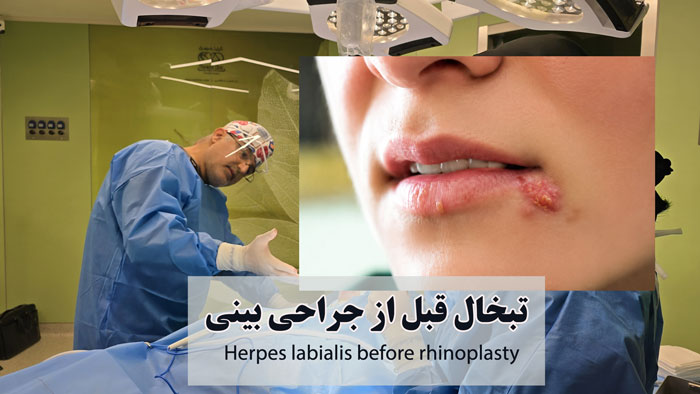 تبخال قبل از عمل جراحی بینی