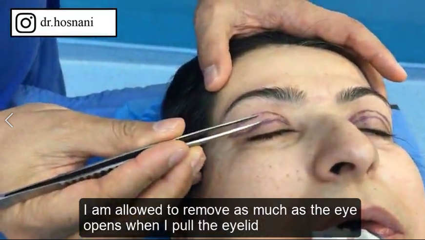 how much allowed to remove