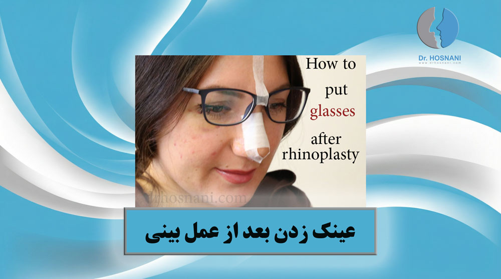 how put glasses after rhinoplasty