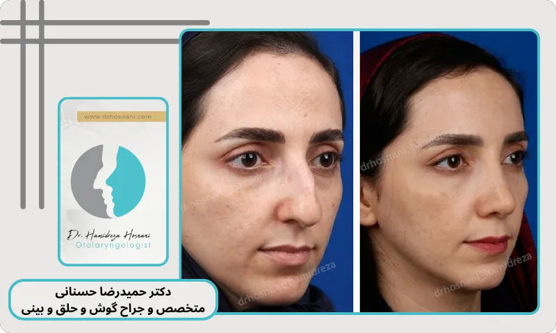 استخوانی طبیعی سه رخ