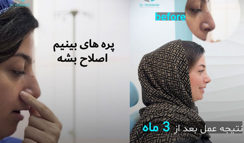 پره های بینی اصلاح بشه