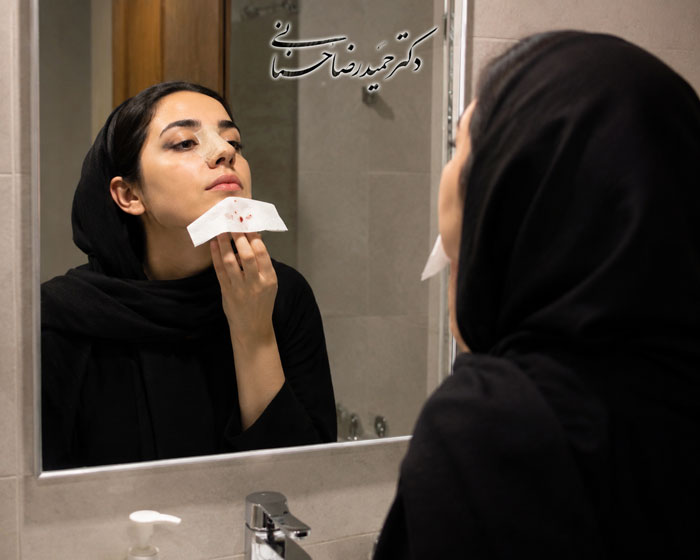 خونریزی بعد از عمل بینی