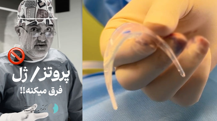 تفاوت پروتز و ژل فیلر