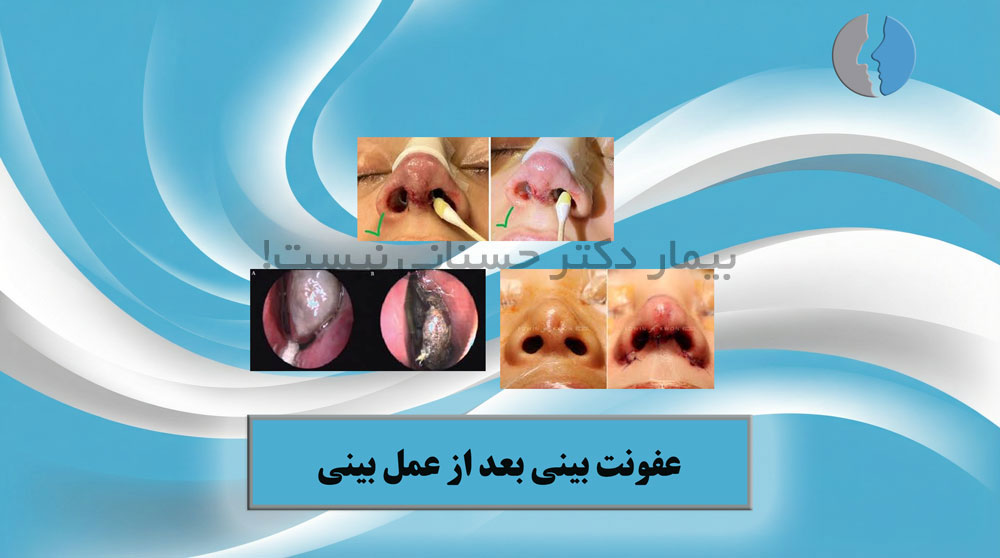 عفونت بینی بعد از عمل بینی