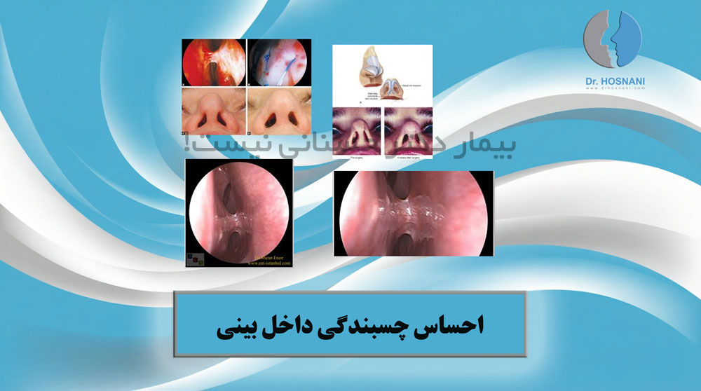 چسبندگی داخل بینی یا سینشیا