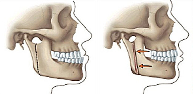 jaw surgery og