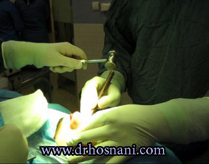 استئوتومی لترال یا کناری