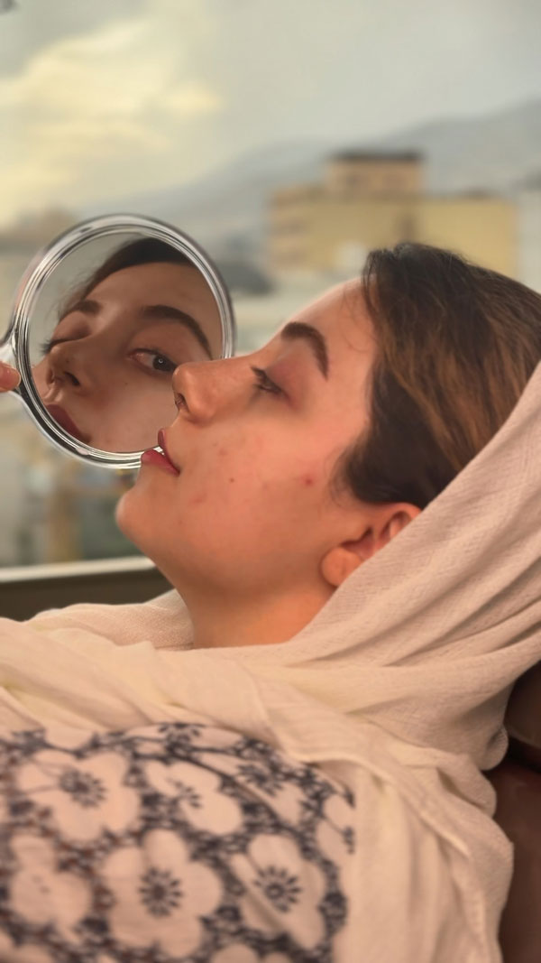 دیدن خود در آینه بعد از برداشتن گچ بینی