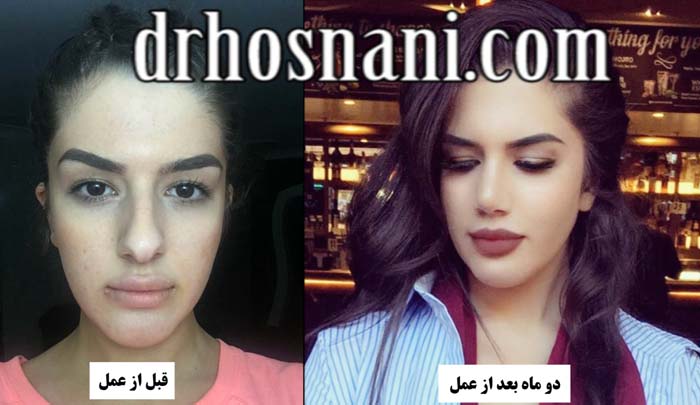 نجیم دو ماه بعد ازعمل