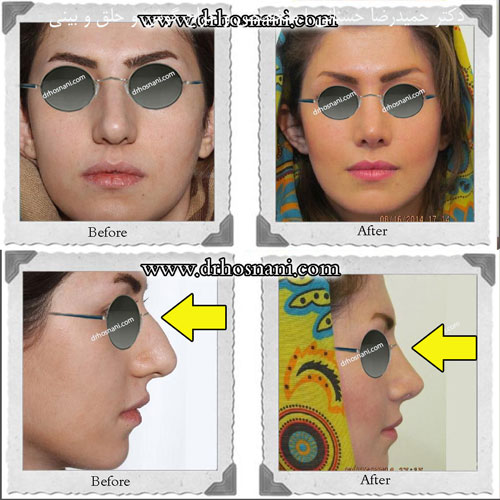 nasal bridge og
