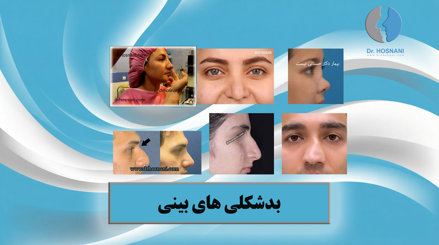 nasal deformities og