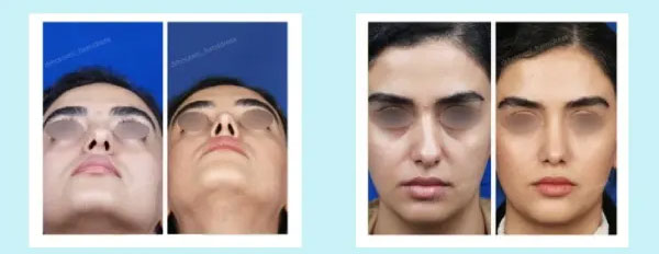 زیر بینی و انحراف بینی
