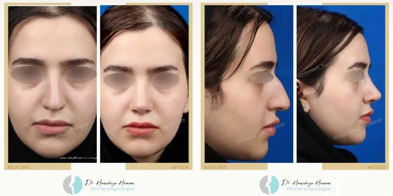 بینی صاف و بدون قوز