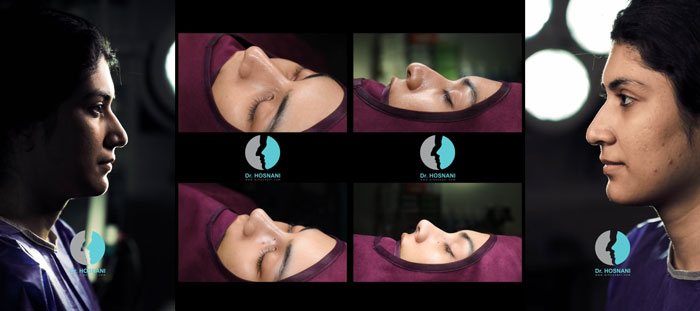 قوز افتادگی نوک بینی، طبیعی