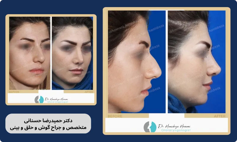 بینی طبیعی