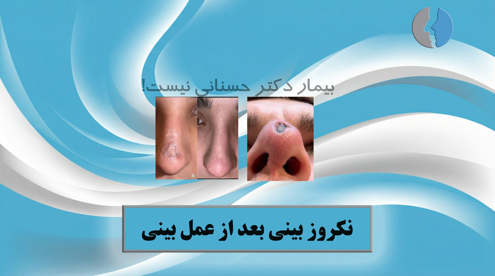 نکروز بینی بعد از عمل