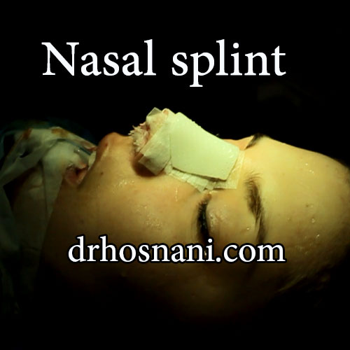 nasal splint og