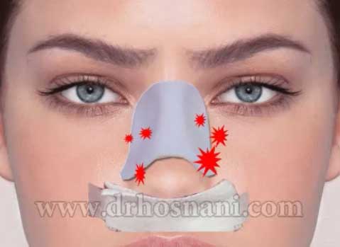 Nose Irritation