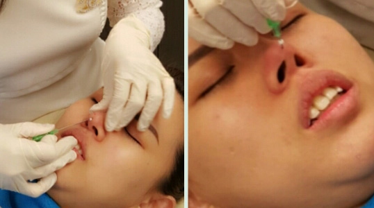 nose lift og