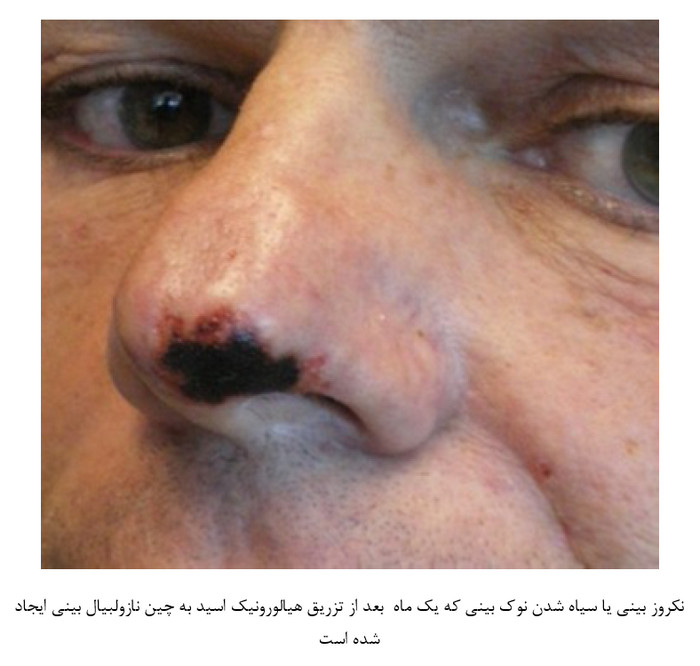 nose necrosis og