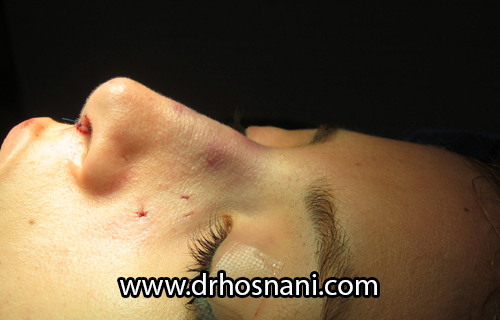 بینی آمال بلافاصله بعد از جراحی بینی