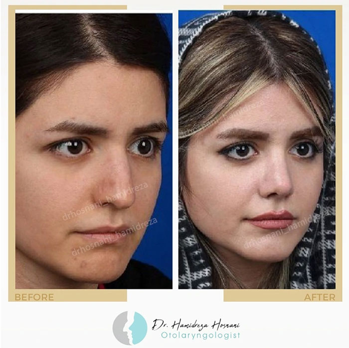 سه رخ کاهش افتادگی