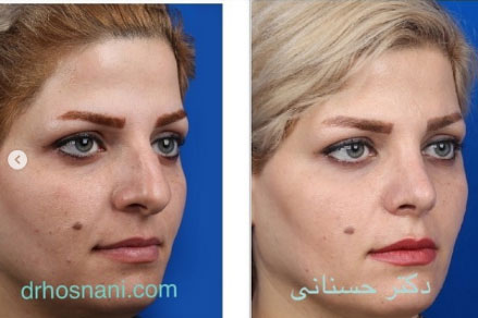 تغییرات بینی در نمای سه رخ: کاهش سایز بینی