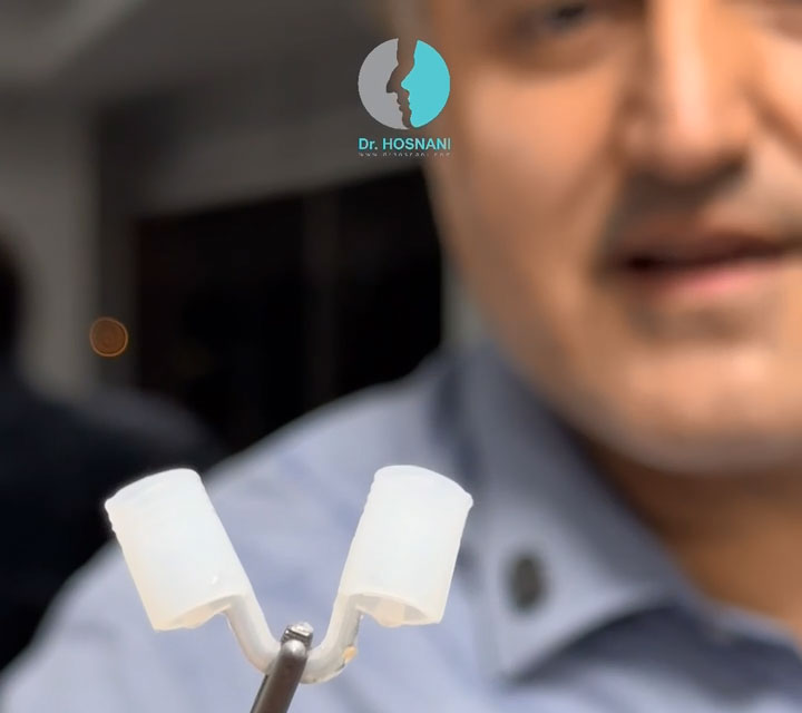 Nasal Retainer یا Nasal Conformer