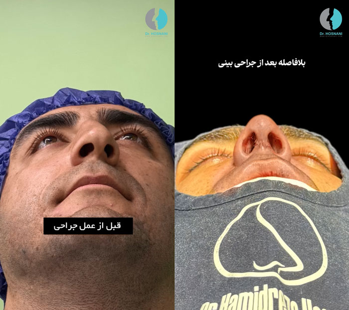 قرینه سازی سوراخ های بینی