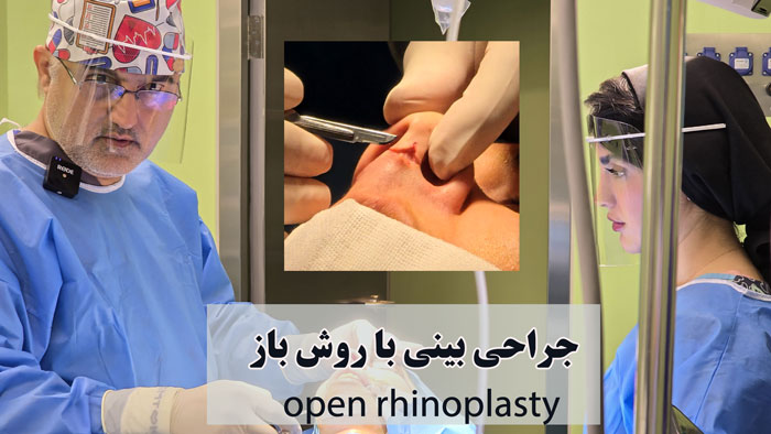 جراحی بینی با روش باز