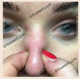 pinched nose og