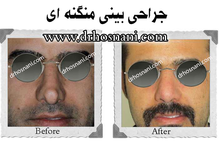 جراحی بینی منگنه ای