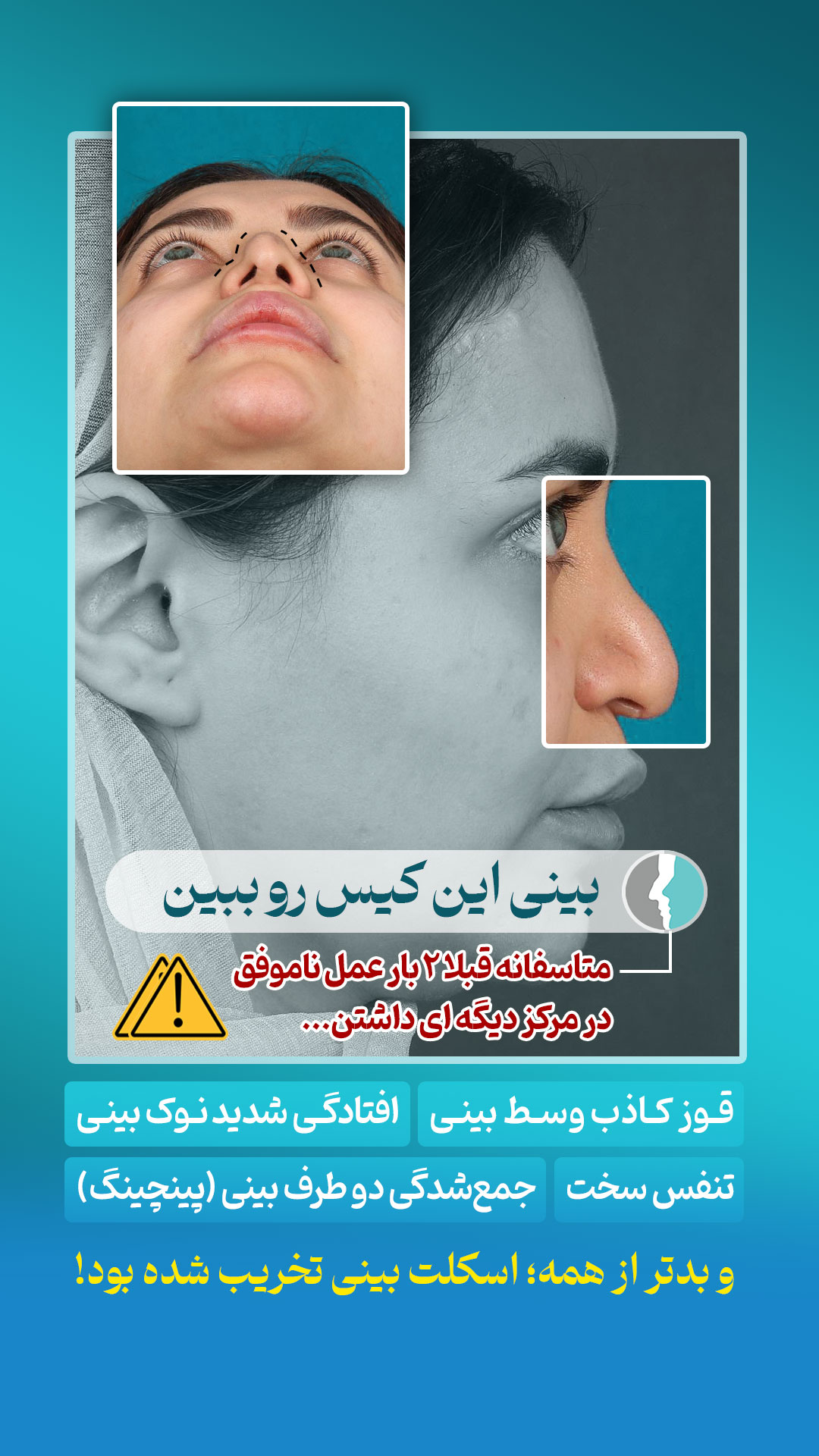 بدشکلی سوراخ های بینی، قوز کاذب، افتادگی بینی