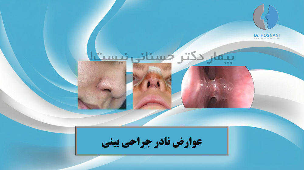 عوارض نادر جراحی بینی