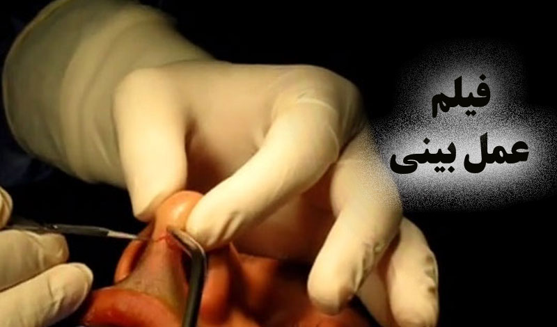 فیلم کامل جراحی بینی دکتر حسنانی؛ واقعاً چطور انجام میشه؟