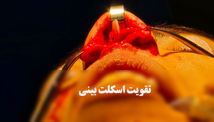 تقویت اسکلت بینی