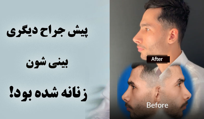 جراحی بینی ترمیمی برای آقایی که قبلا بینی اش دخترانه عمل شده بود